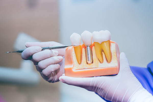 Image of dental professional pointing to a dental implant model, at The Center for Esthetic Dentistry in Grants Pass, OR.