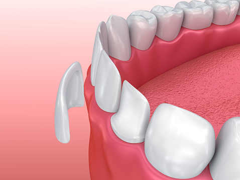 Close up of dental veneer at The Center for Esthetic Dentistry in Grants Pass, OR