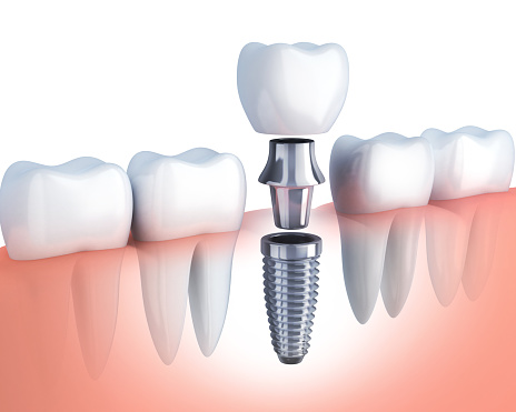 Single tooth implant in row of teeth