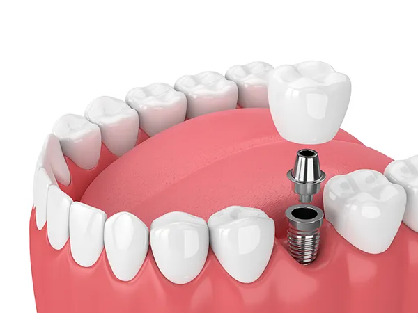 Rendering of jaw with dental implant at Grants Pass, OR.