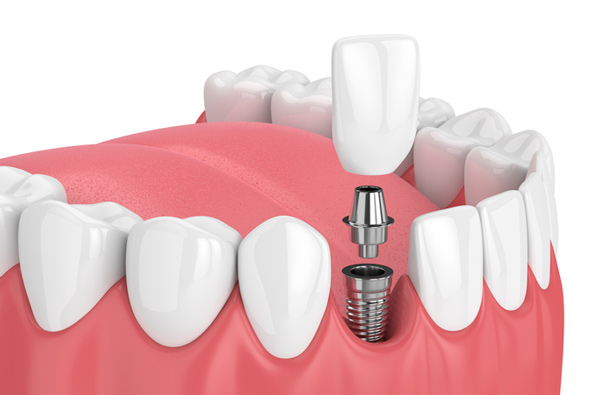 Rendering of jaw with dental implant at The Center for Esthetic Dentistry in Grants Pass, OR.