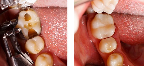 Photo of dental fillings from The Center for Esthetic Dentistry in Grants Pass, OR