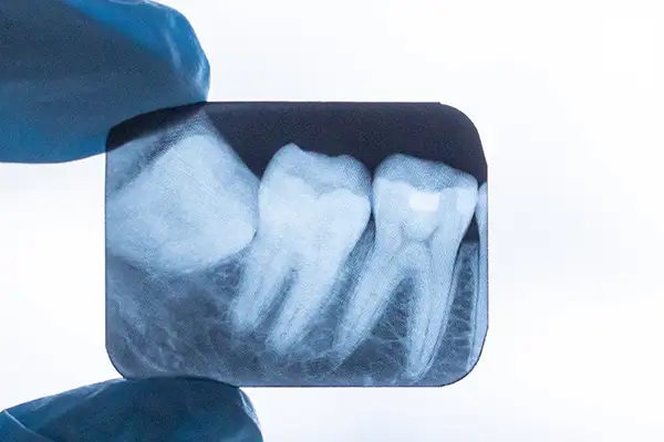 A close-up of a dental X-ray showing the position and alignment of an impacted wisdom tooth.